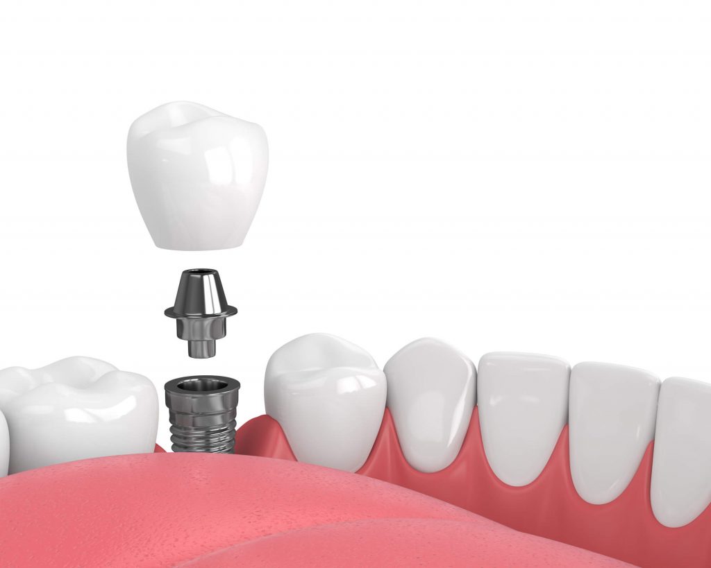 dental-implants-oral-surgery-98115