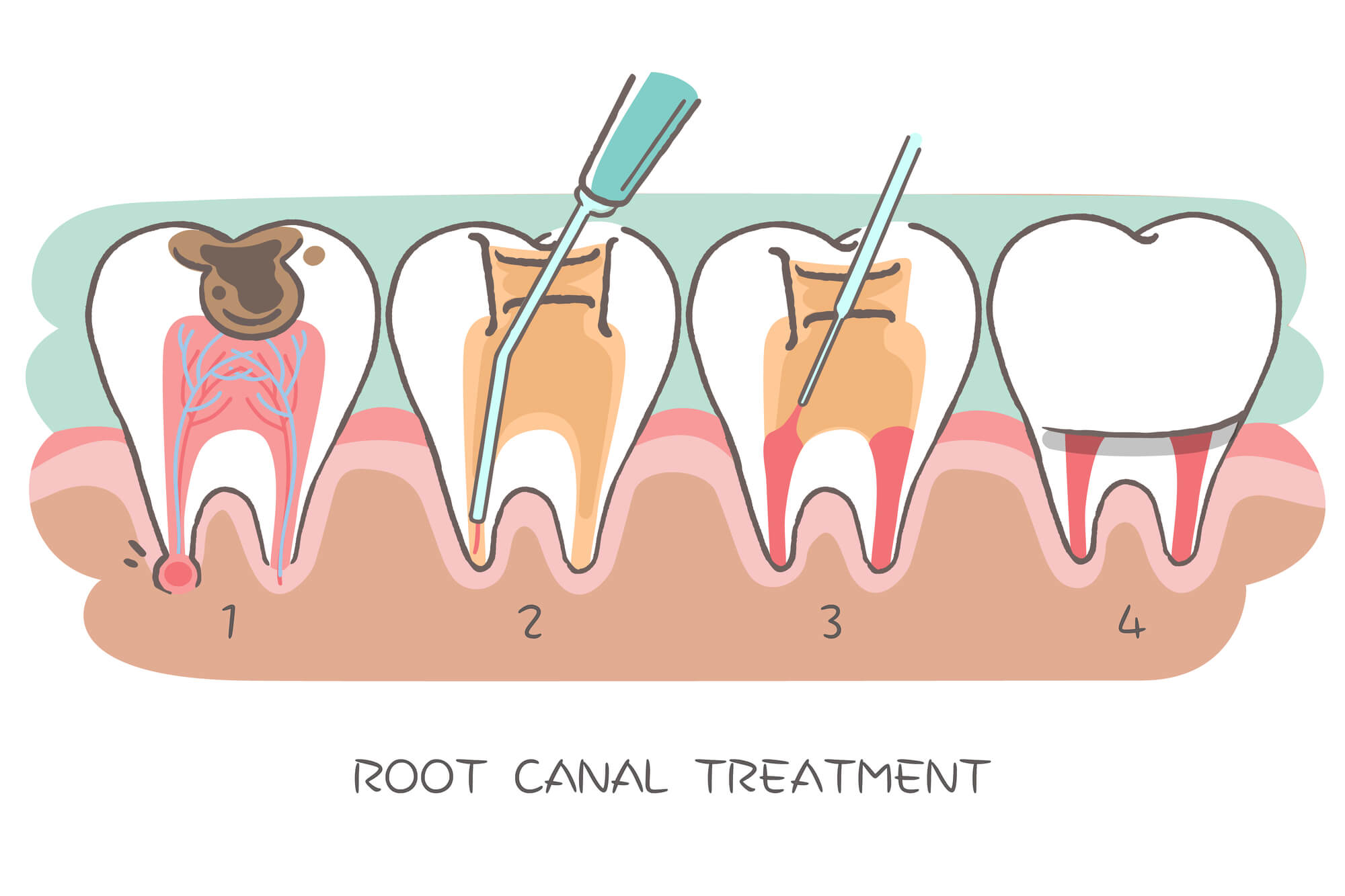 Where can I get a Root canal 98115?