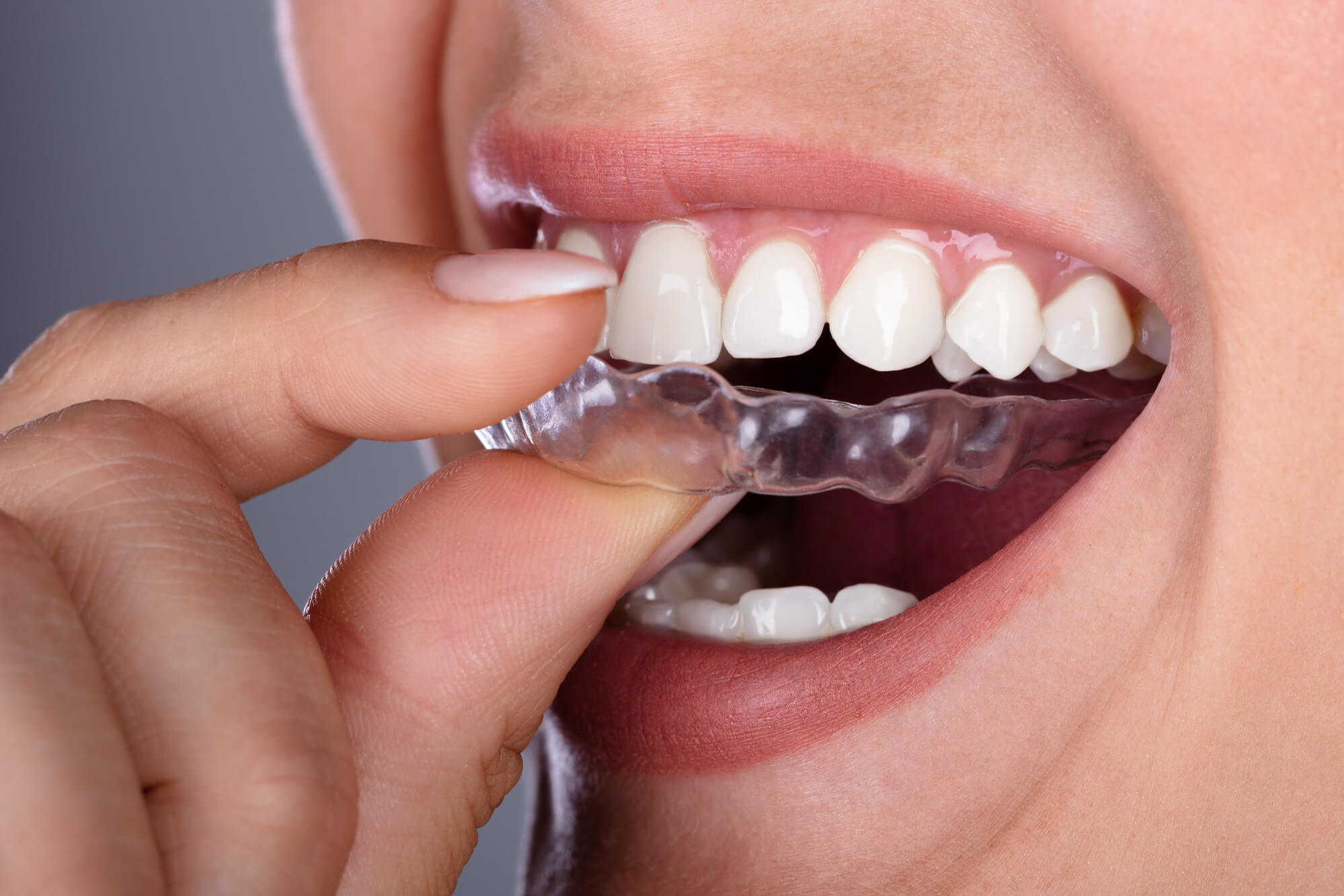 How do I get Invisalign in 98115?