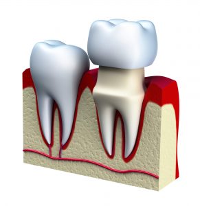 Where can I get dental crowns in 98115?