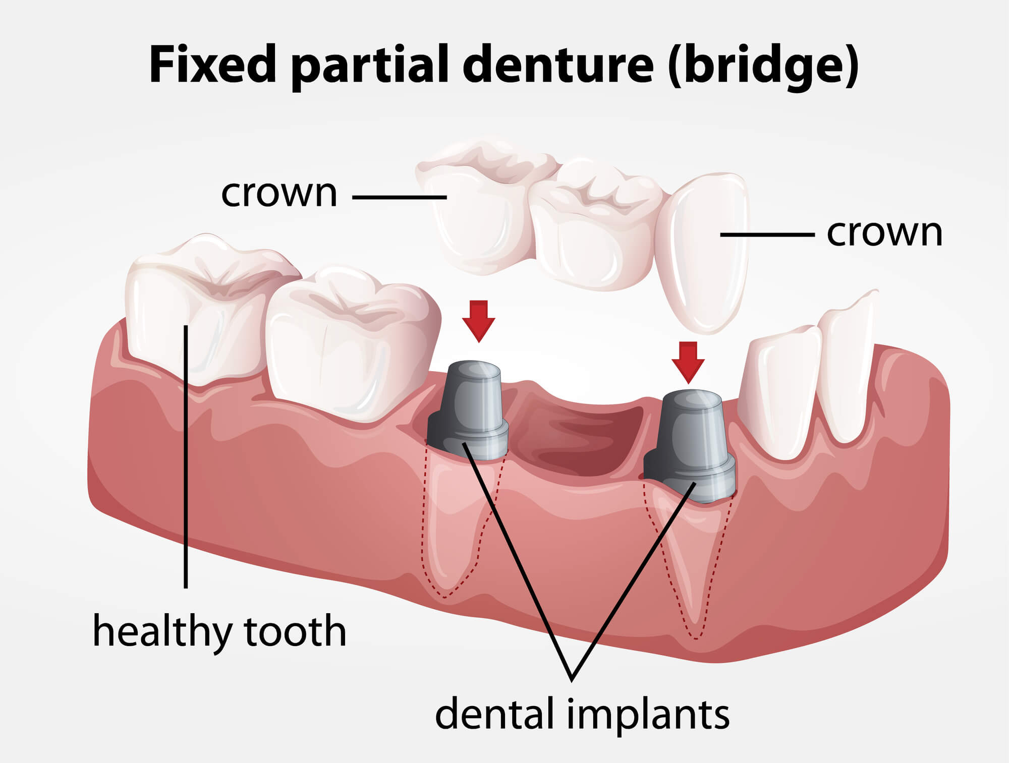 diagram Porcelain Dental bridges 98115