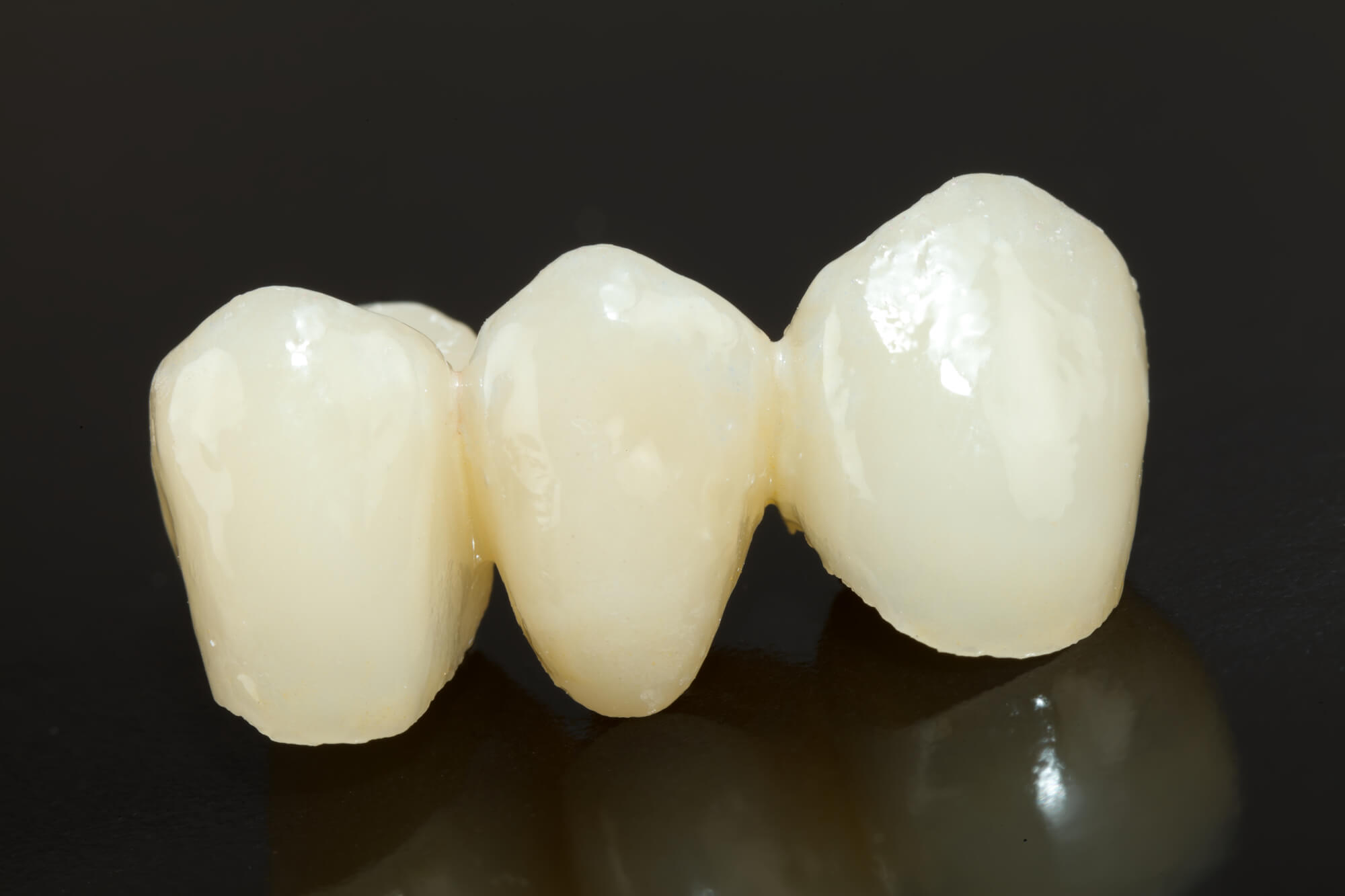 Porcelain Dental bridges 98115